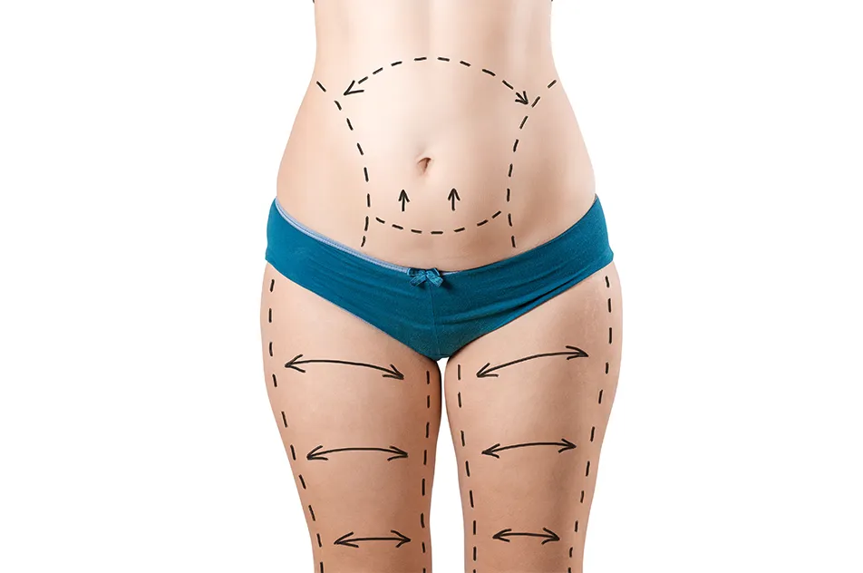 vaser liposuction body areas marking
