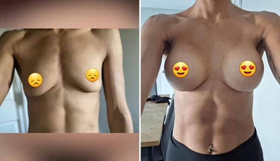 breast augmentation before and after-1