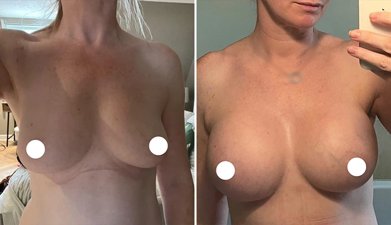 breast augmentation before and after results