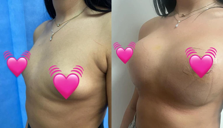breast augmentation patient-1
