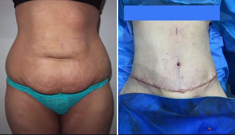 abdominoplasty before and after result