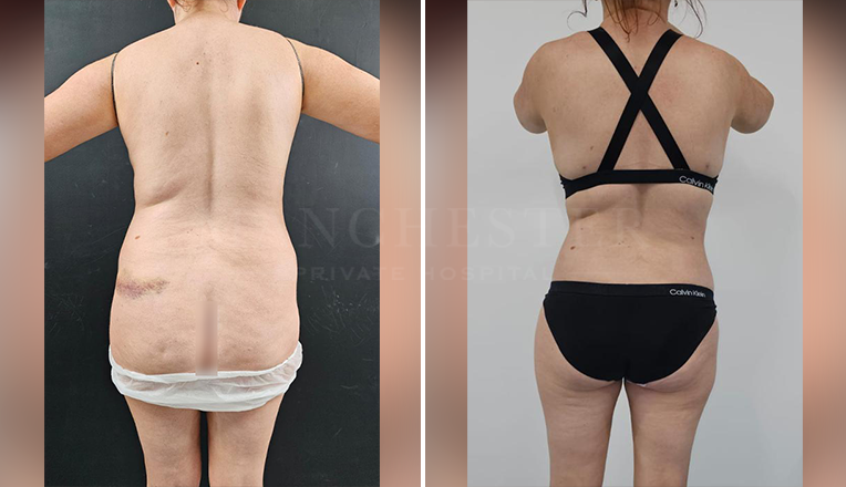 back vaser lipo before and after-1