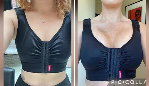 breast augmentation patient results -2