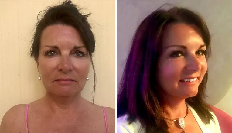 facelift before and after result-1