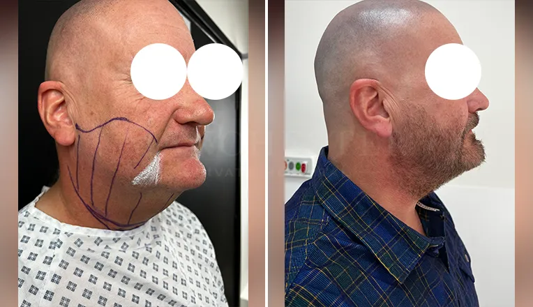 facial vaser lipo before and after-1