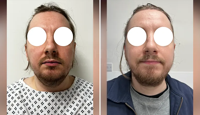 facial vaser liposuction before and after-1