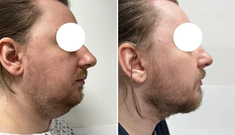 facial vaser liposuction before and after result-1