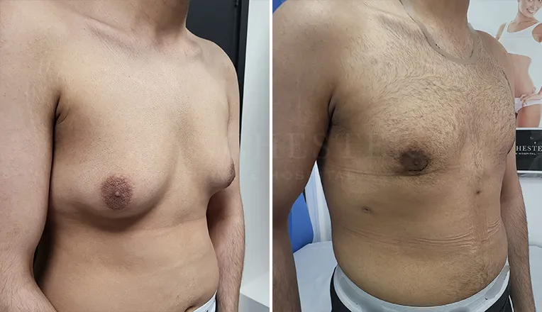 gynecomastia before and after result