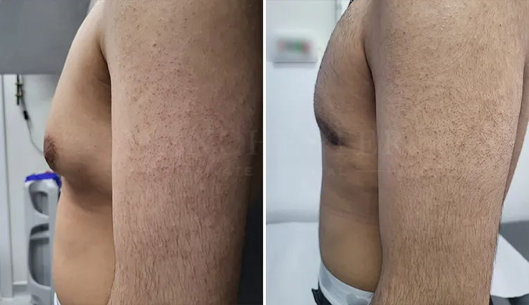 gynecomastia liposuction before and after-1