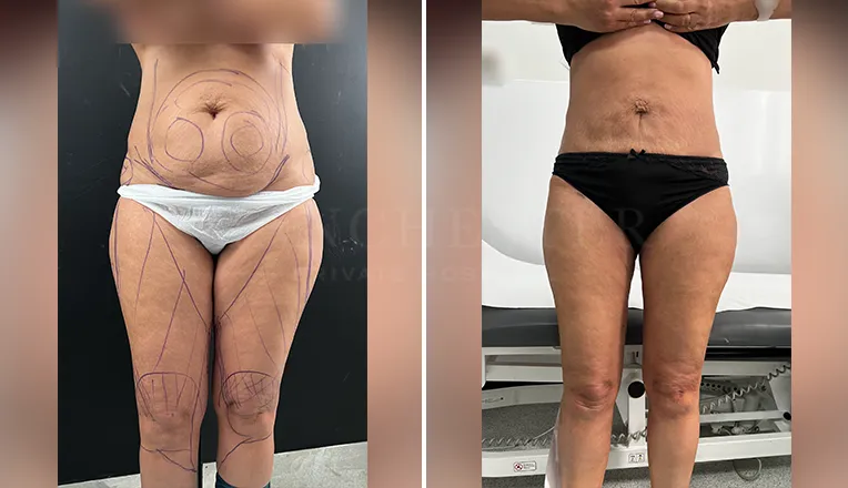 stomach vaser lipo before and after result