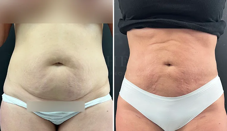 stomach vaser lipo before and after