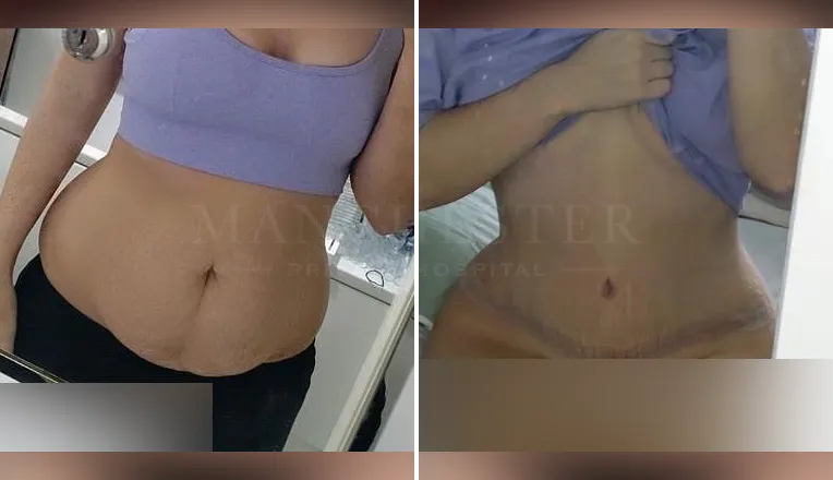 tummy tuck before and after result-3