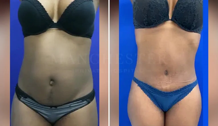 tummy tuck before and after result