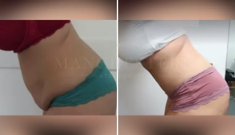 tummy tuck before and after uk-2