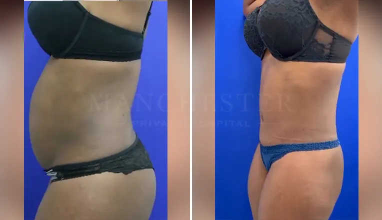 tummy tuck before and after uk
