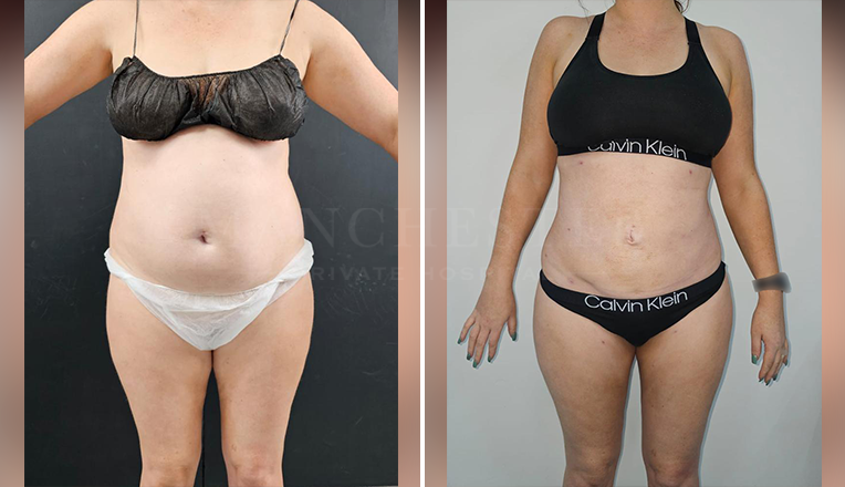 vaser lipo before and after stomach-1