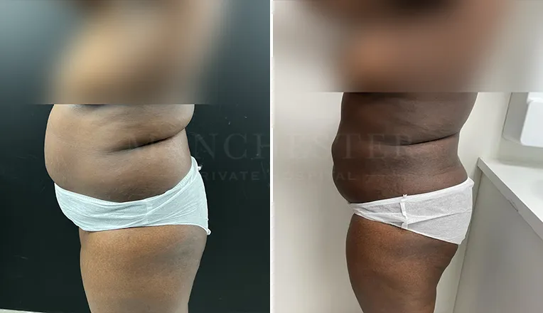 vaser lipo female abs before and after-1