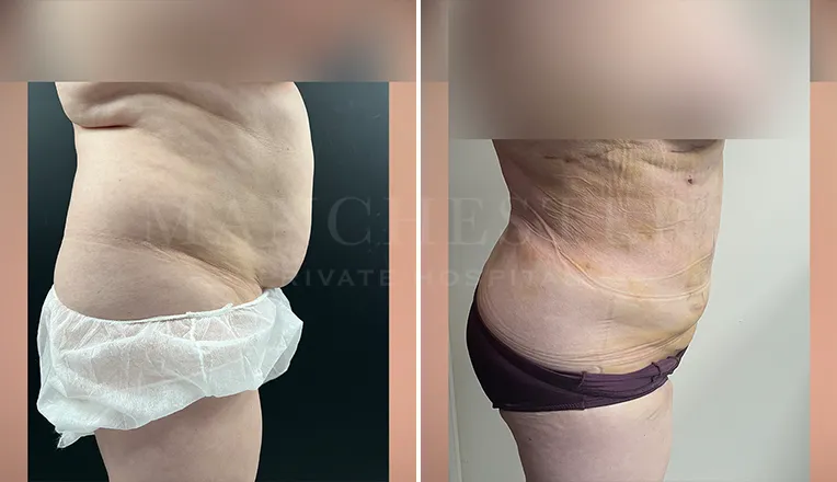 vaser lipo female abs before and after - 2