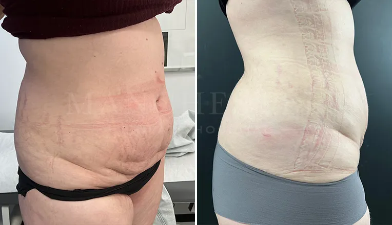 vaser lipo female abs before and after result - 1