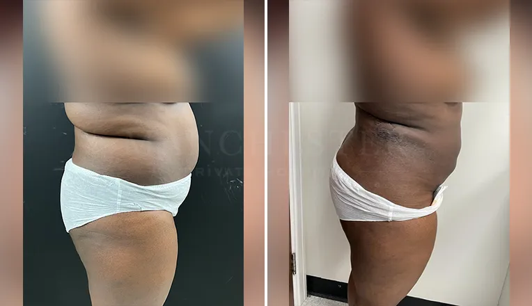 vaser lipo female abs before and after result - 2