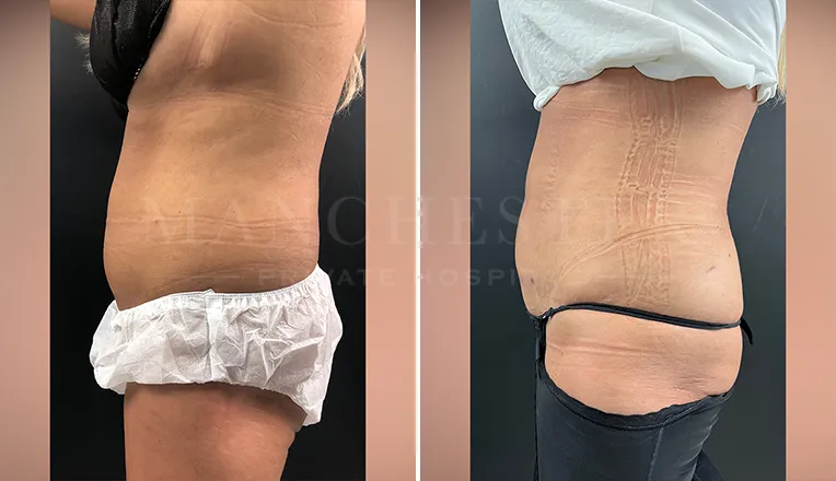 vaser lipo female abs before and after result