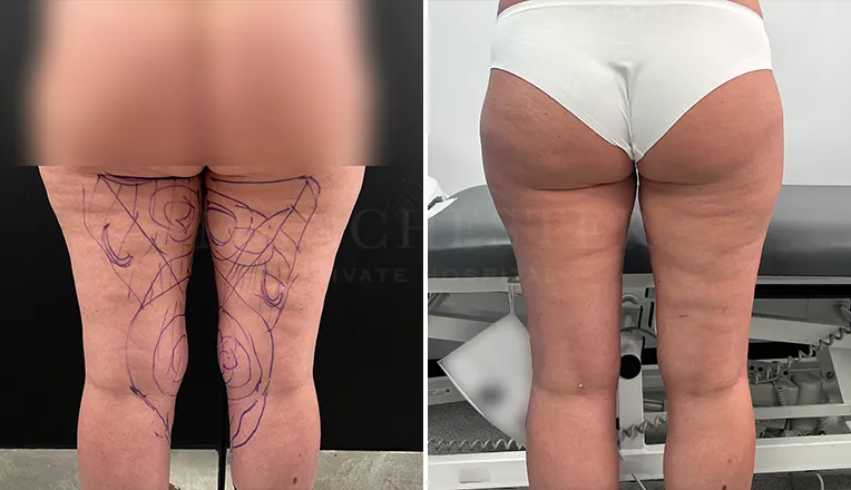 vaser lipo legs before and after-1
