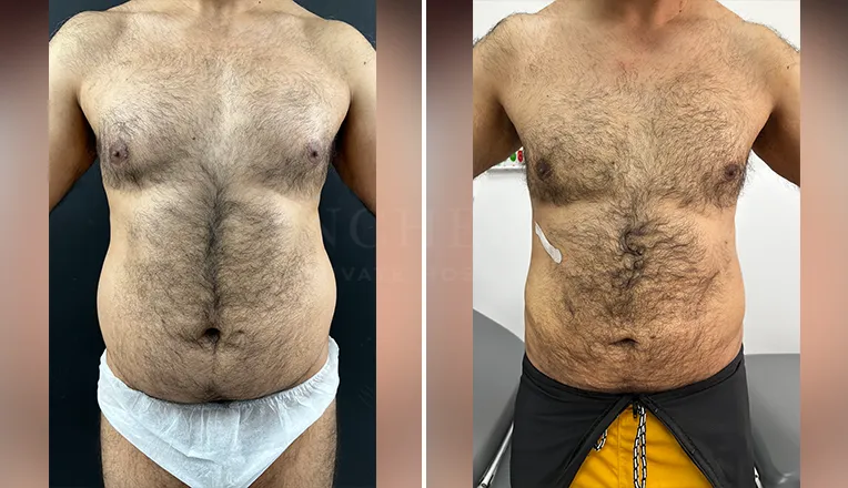 vaser lipo male before and after-1