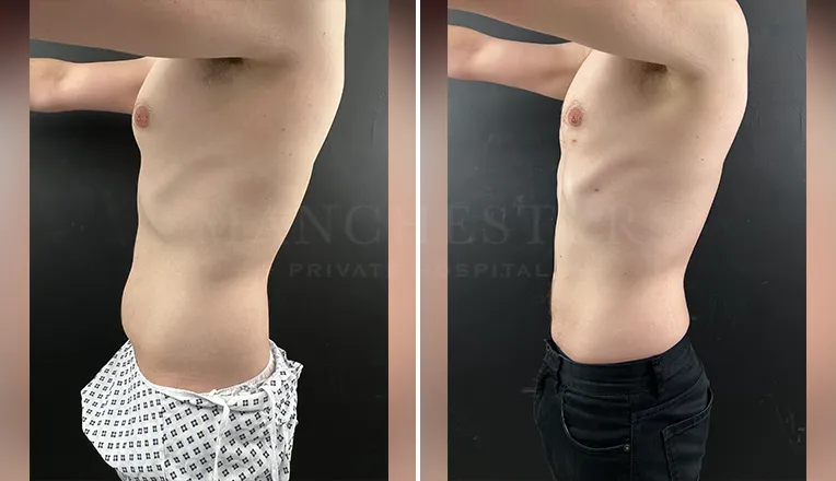 vaser lipo male before and after result