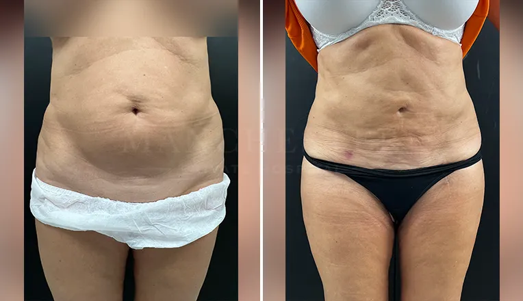 vaser liposuction before and after stomach
