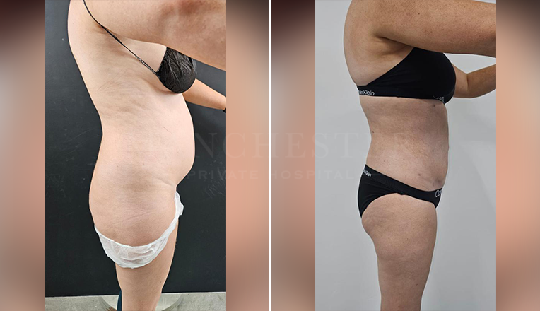 vaser liposuction female abs before and after