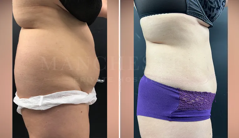 vaser liposuction female abs before and after - 1