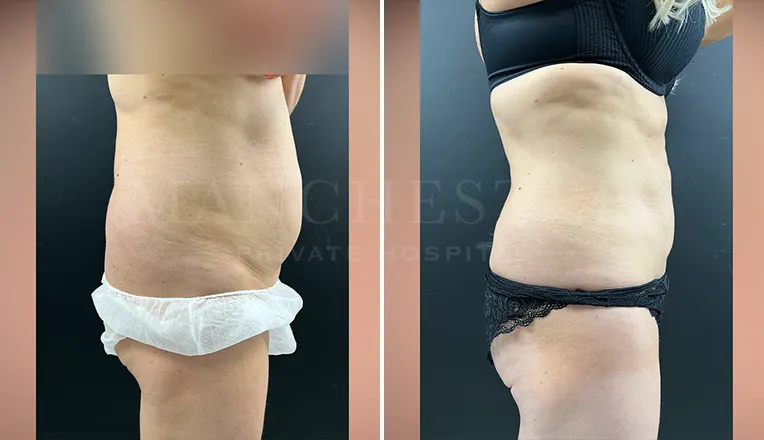 vaser liposuction female abs before and after - 2