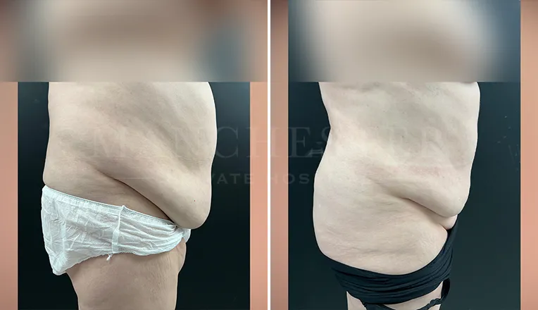 vaser liposuction female abs before and after result -1
