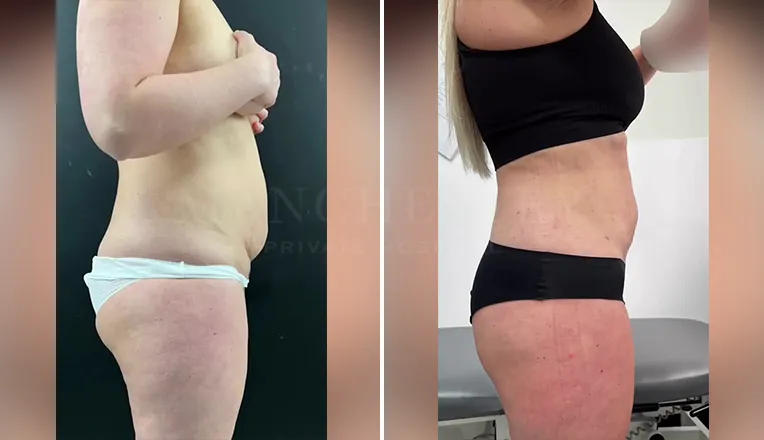 vaser liposuction female abs before and after result - 2