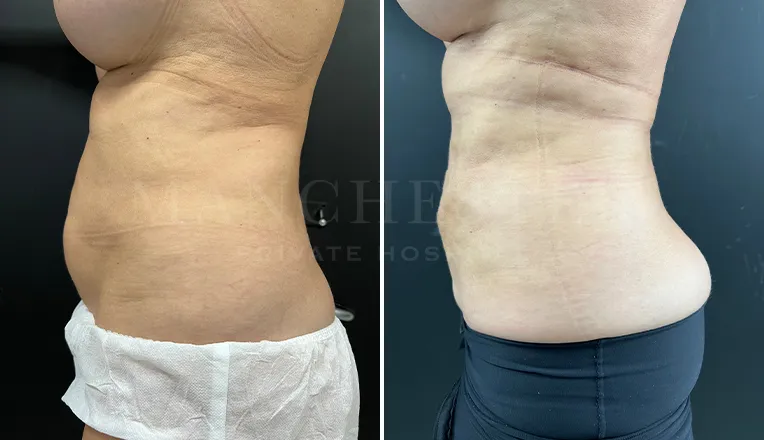vaser liposuction female abs before and after