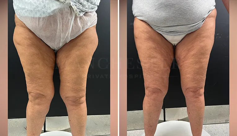vaser liposuction legs before and after result