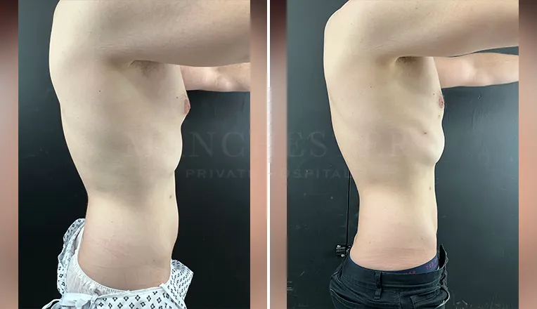 vaser liposuction male before and after result