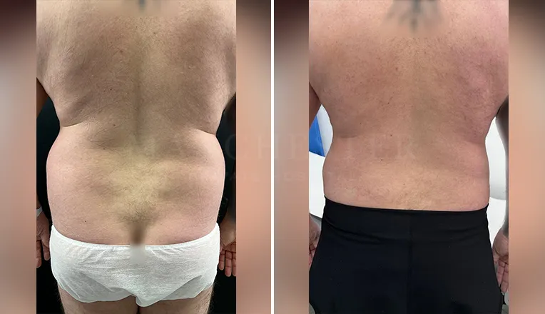 vaser liposuction male before and after