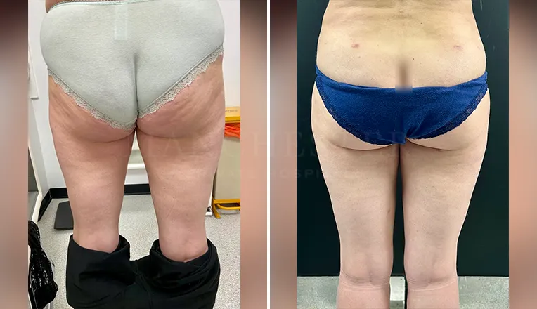 vaser liposuction thighs before after-1