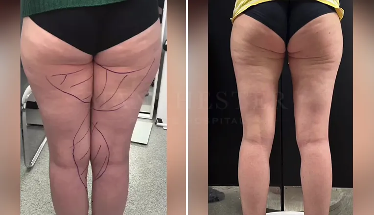 vaser liposuction thighs before after result