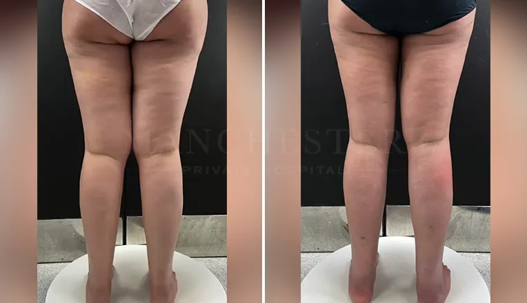 vaser liposuction thighs before after