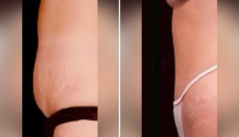 abdominoplasty before and after result-7