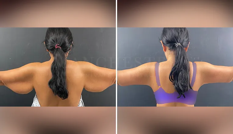 arm vaser liposuction before and after - 1 -v2