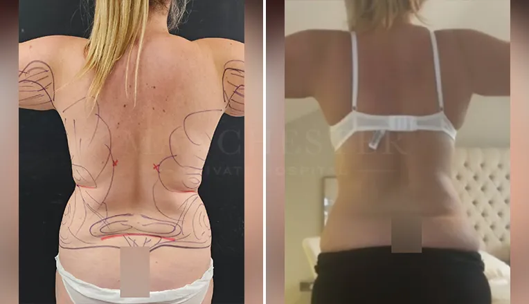 back vaser lipo before and after-3