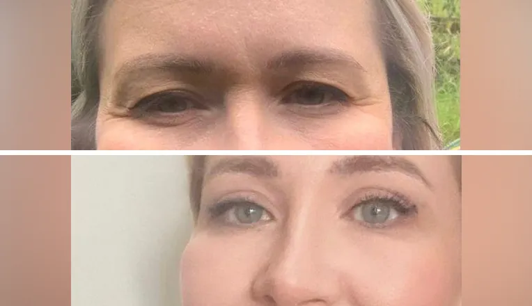 blepharoplasty before and after patient - 1