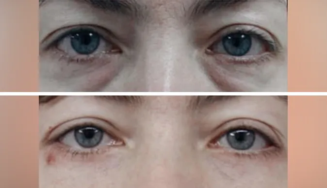 blepharoplasty before and after patient - 10