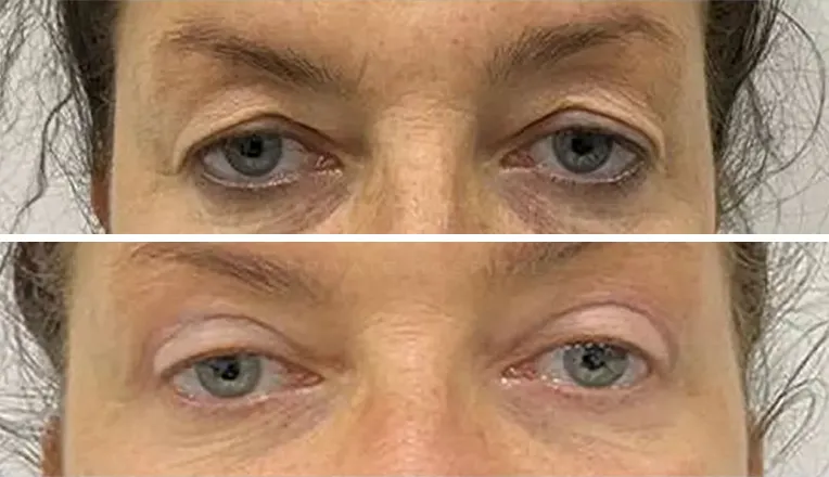 blepharoplasty before and after patient - 12