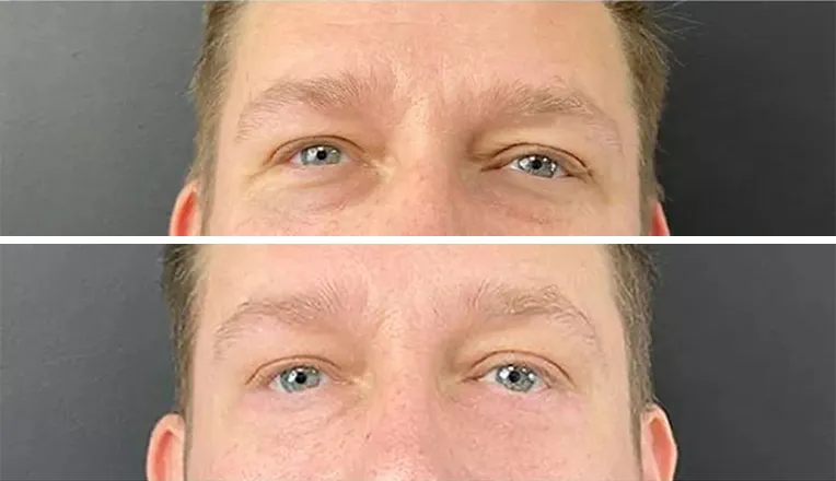 blepharoplasty before and after patient - 14