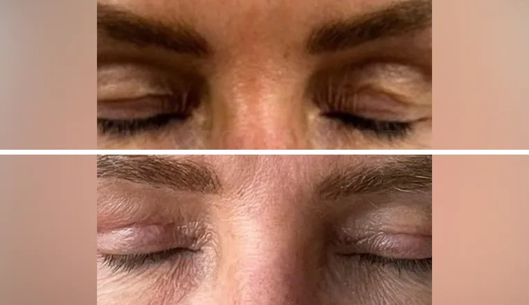 blepharoplasty before and after patient - 2