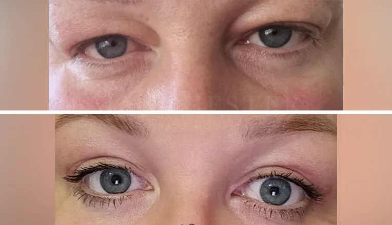 blepharoplasty before and after patient - 3
